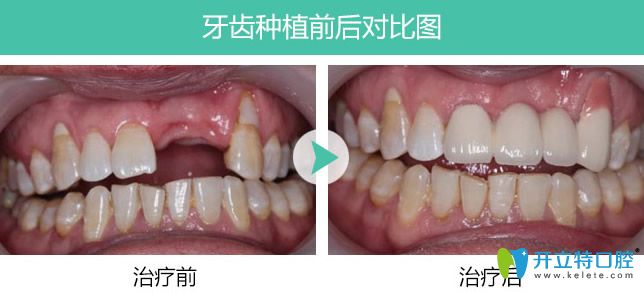 長(zhǎng)春超龍牙博士多顆牙缺失種植案例對(duì)比圖
