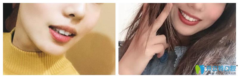 泰州北極星口腔隱形矯正案例前后效果對(duì)比圖 泰州北極星口腔隱形矯正案例前后效果對(duì)比圖