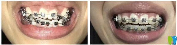 牙齒正畸前后對比照