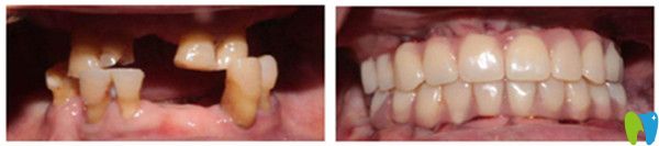 All-on-4全口種植牙前后對比圖