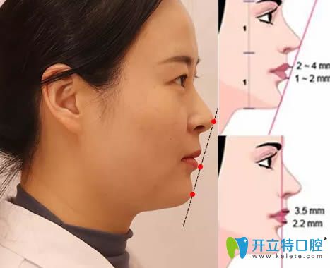 無錫佳士潔口腔賈艷講解正畸中的面部美學(xué)參考 無錫佳士潔口腔賈艷講解正畸中的面部美學(xué)參考