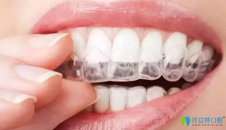 正畸咬膠使隱形牙套更貼合，更隱形