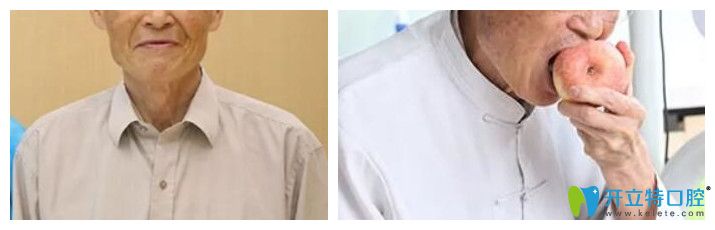 好佰年口腔全口牙即刻負(fù)重種植案例