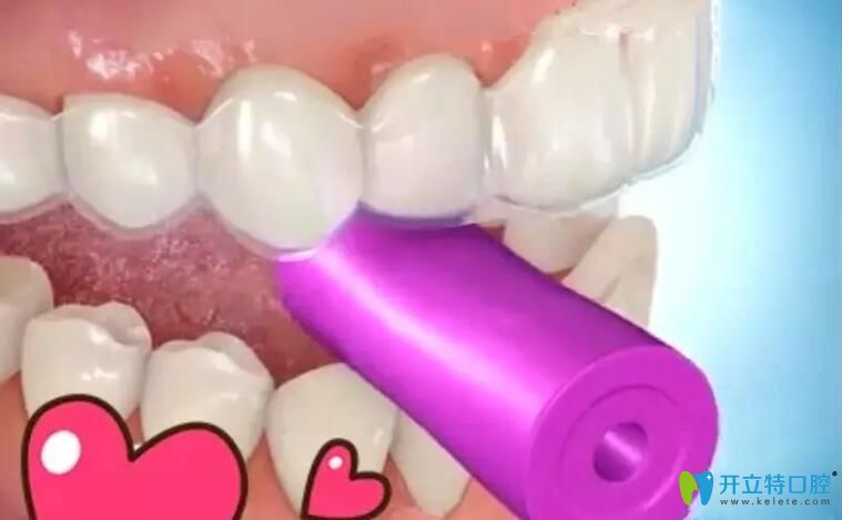 正畸咬膠如何正確咬