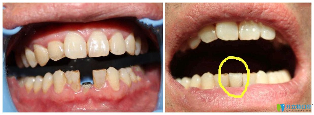 中山好民生口腔單顆種植牙案例