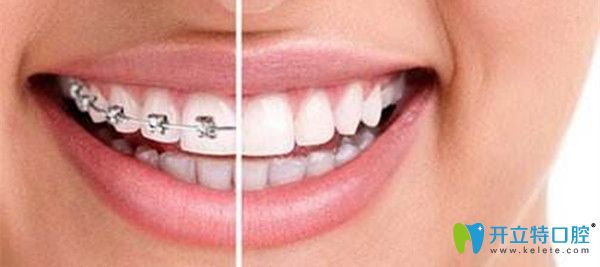 列舉深圳牙齒矯正好且正規(guī)的口腔機(jī)構(gòu),附價格表及顧客評價