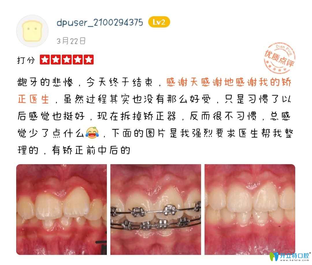 在<!--<i data=20240703-sp></i>-->做正畸后的點評