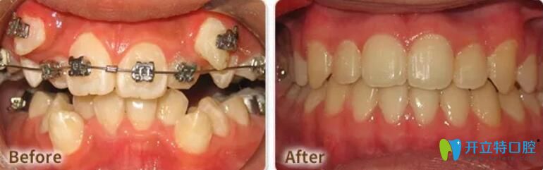 東莞好佰年口腔虎牙矯正案例前后效果對比