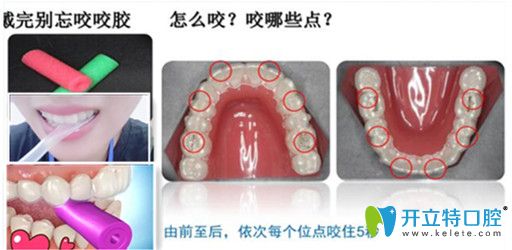 每次戴牙套的時(shí)候必須要用正畸咬膠