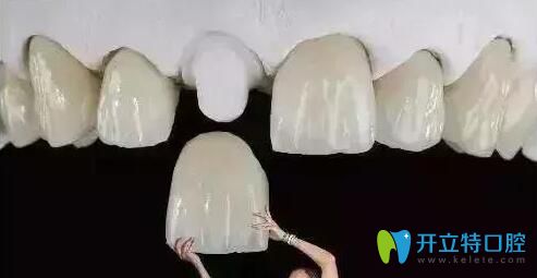 解答：做了全瓷牙基牙爛掉的概率高嗎？