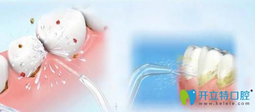 牙周治療和洗牙的區(qū)別
