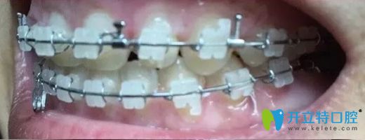 北京康貝佳口腔陶瓷牙套正畸7個(gè)月牙齒側(cè)面效果圖