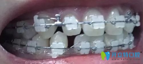 北京康貝佳口腔剛戴牙套時(shí)牙齒稀疏的照片