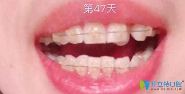 陶瓷托槽矯正第1個月