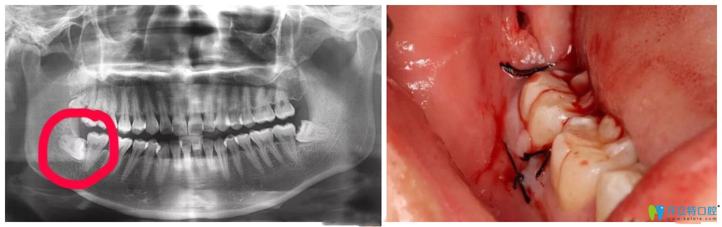 超聲骨刀拔牙真實案例