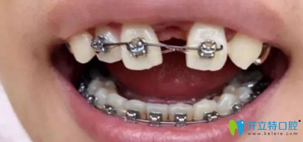 拔了一顆上牙后戴上了上牙套 拔了一顆上牙后戴上了上牙套