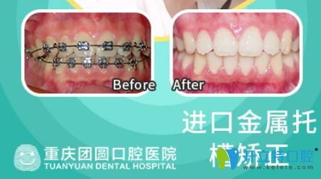 重慶團(tuán)圓口腔真人矯正案例