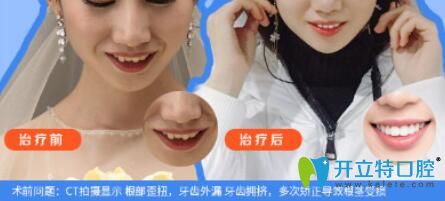 仁愛口腔牙齒外漏、擁擠矯正案例