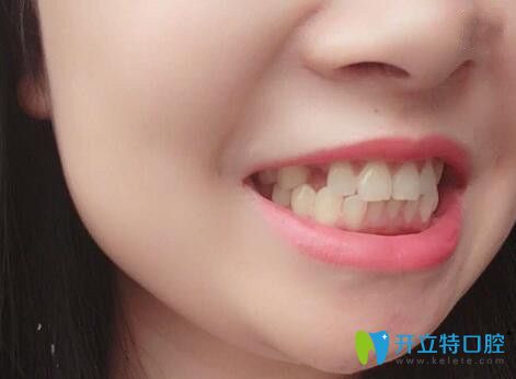 磨牙缺失后我找廣州廣大口腔荔灣分院張力做了即刻種植牙