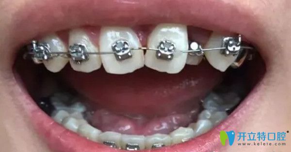 戴上上牙套的第三個月 戴上上牙套的第三個月