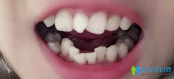 沒有戴牙套前牙齒的照片 沒有戴牙套前牙齒的照片