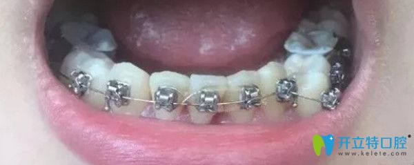 三個月的時間下牙排齊了 三個月的時間下牙排齊了