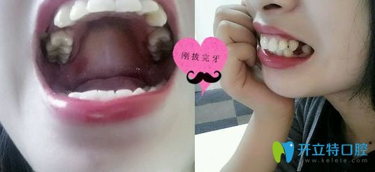 在深圳潤澤瑞尼絲口腔剛拔完牙的照片 在深圳潤澤瑞尼絲口腔剛拔完牙的照片