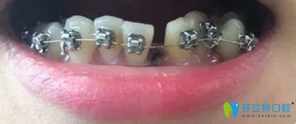 拔了一顆下牙后戴牙套的圖片 拔了一顆下牙后戴牙套的圖片