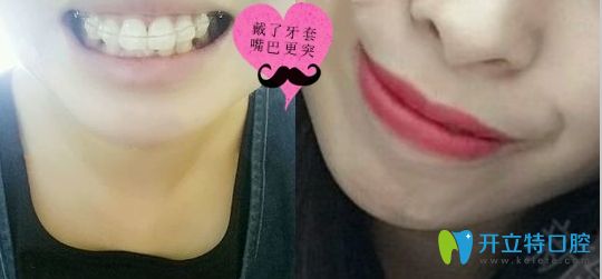 深圳潤澤瑞尼絲口腔戴了陶瓷托槽牙套矯正 深圳潤澤瑞尼絲口腔戴了陶瓷托槽牙套矯正