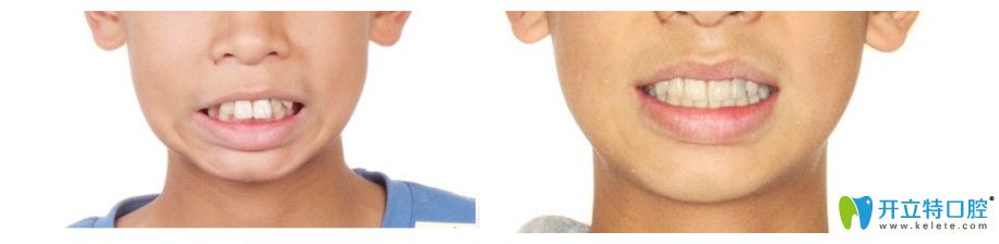 重慶牙博士口腔全隱形矯正對(duì)比