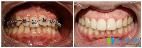 LH魔幻記憶矯正技術(shù)前后對(duì)比圖