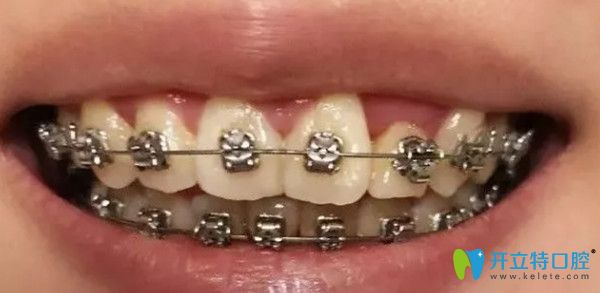 金屬托槽矯正前后對比圖 金屬托槽矯正前后對比圖