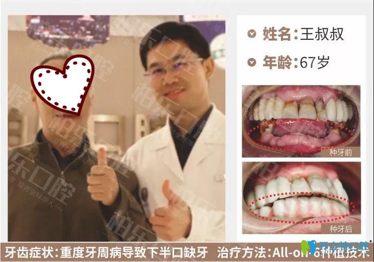 南寧柏樂口腔半口種植牙案例