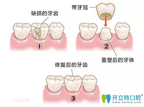 重慶維樂口腔王鳳醫(yī)生介紹全瓷冠修復優(yōu)勢