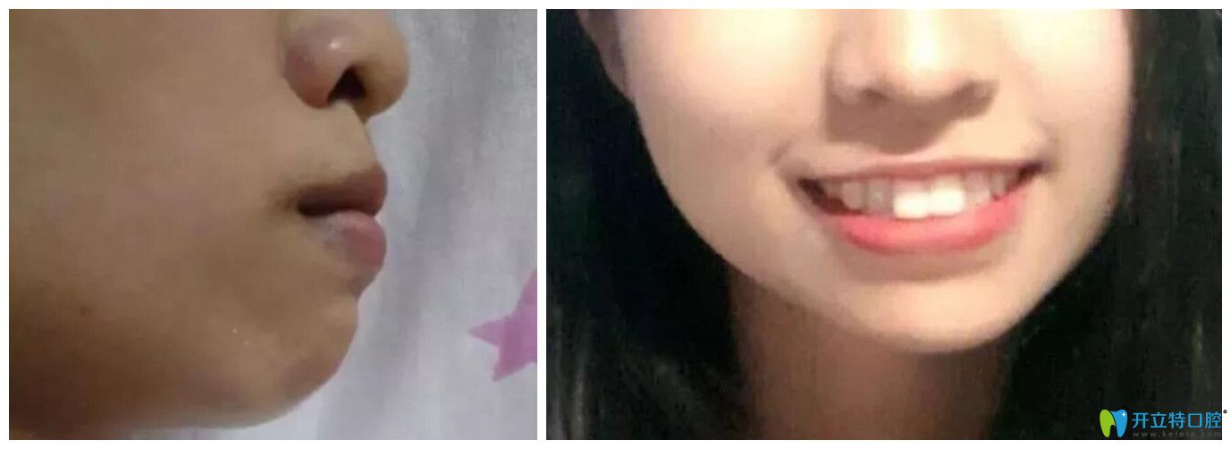門牙前突在西安藝星做矯正22個月，下牙套后臉型變化很大
