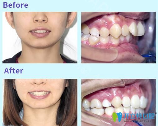 沈陽(yáng)歡樂口腔牙齒矯正案例