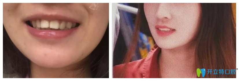 西安哪個醫(yī)院矯正牙齒比較好？來看藝星牙齒矯正案例