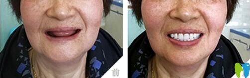 沈陽(yáng)歡樂口腔種植牙案例