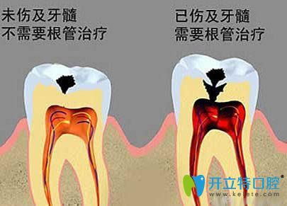  周東峰科普牙體牙髓病為什么要做根管治療