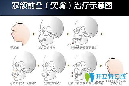 廣州廣大口腔正頜治療示意圖