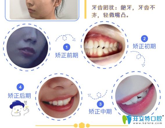 格倫菲爾正畸過(guò)程牙齒變化圖