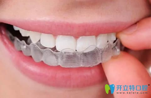 杜如醫(yī)生談隱形牙套矯正的優(yōu)勢