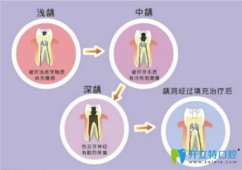 包紫雨醫(yī)生科普牙體牙髓病的治療方法