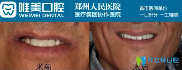 鄭州唯美50歲老人3D數字化半口種植牙效果圖