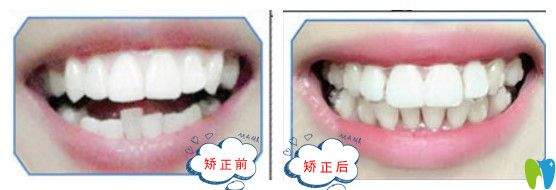 清遠中大時代天使隱形矯正前后圖