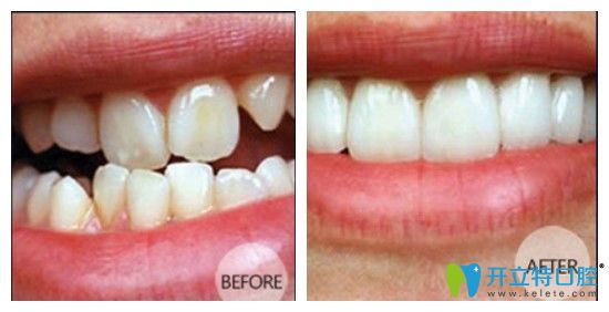 清遠中大口腔金屬托槽矯正前后圖