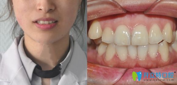 濟(jì)南正畸哪家醫(yī)院好?韓氏醫(yī)院口腔科金屬牙齒矯正就很贊!