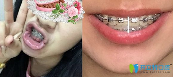 濟南韓氏口腔金屬托槽牙套矯正1年效果圖
