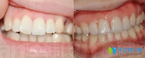 濟(jì)南韓氏口腔牙性齙牙矯正效果對比圖