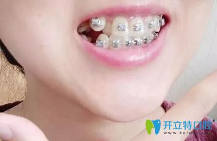 廣州壹加壹口腔戚志鋒給我做牙齒矯正第3個(gè)月